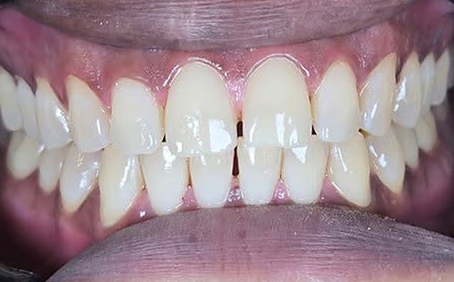 After: Advanced teeth whitening