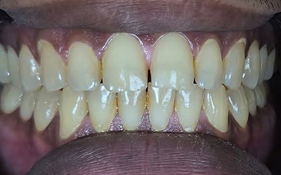 Before: Advanced teeth whitening
